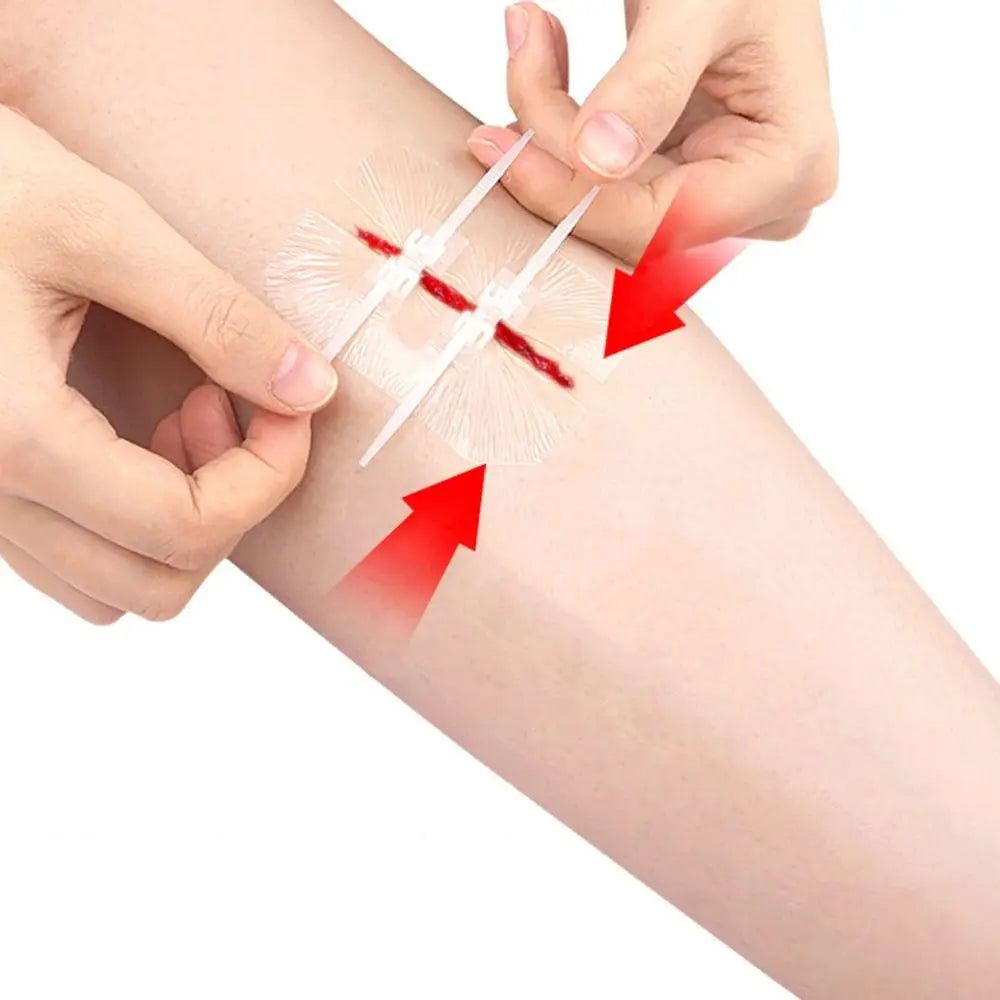 Adhesive Wound Care Zip Sutures Bandaids without Stitches First Aid Zipper Laceration Repair Emergency Laceration Closures